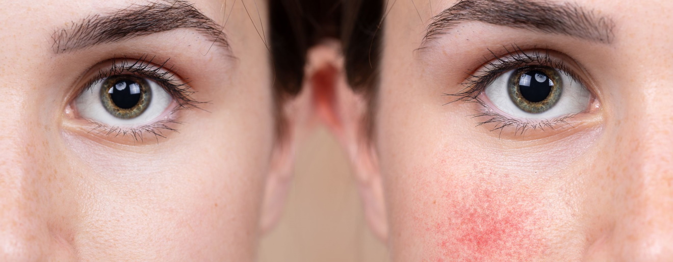 Pielęgnacja skóry z trądzikiem różowatym