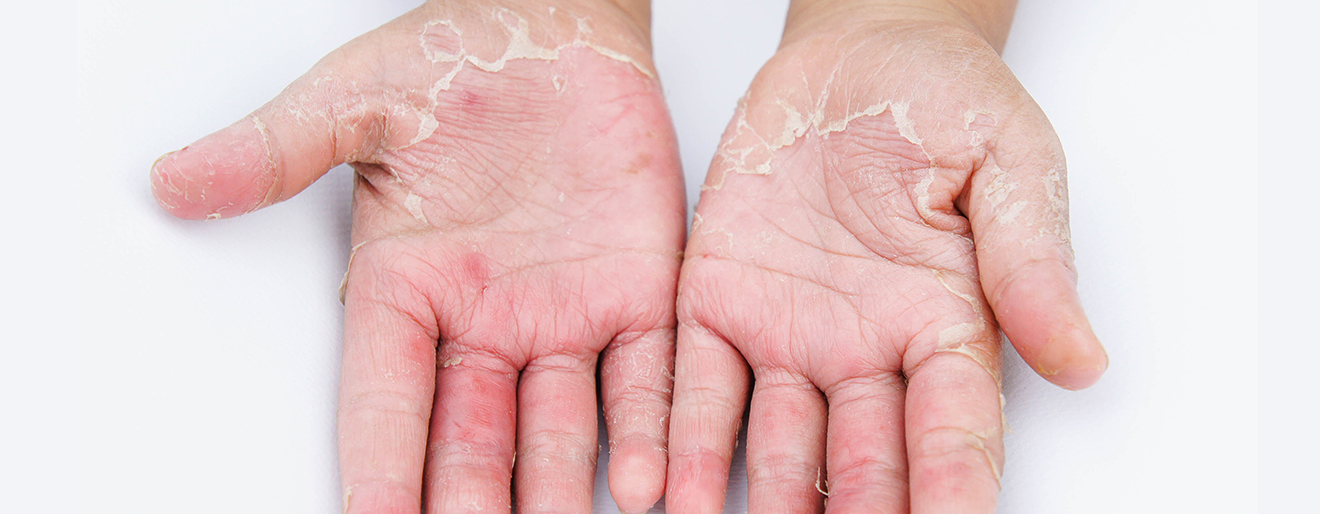 Właściwa pielęgnacja skóry z łuszczycą