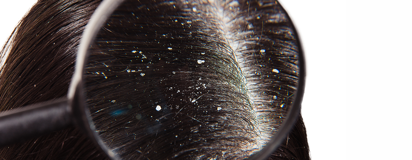 Problem łupieżu i wypadania włosów - jak się go skutecznie pozbyć?