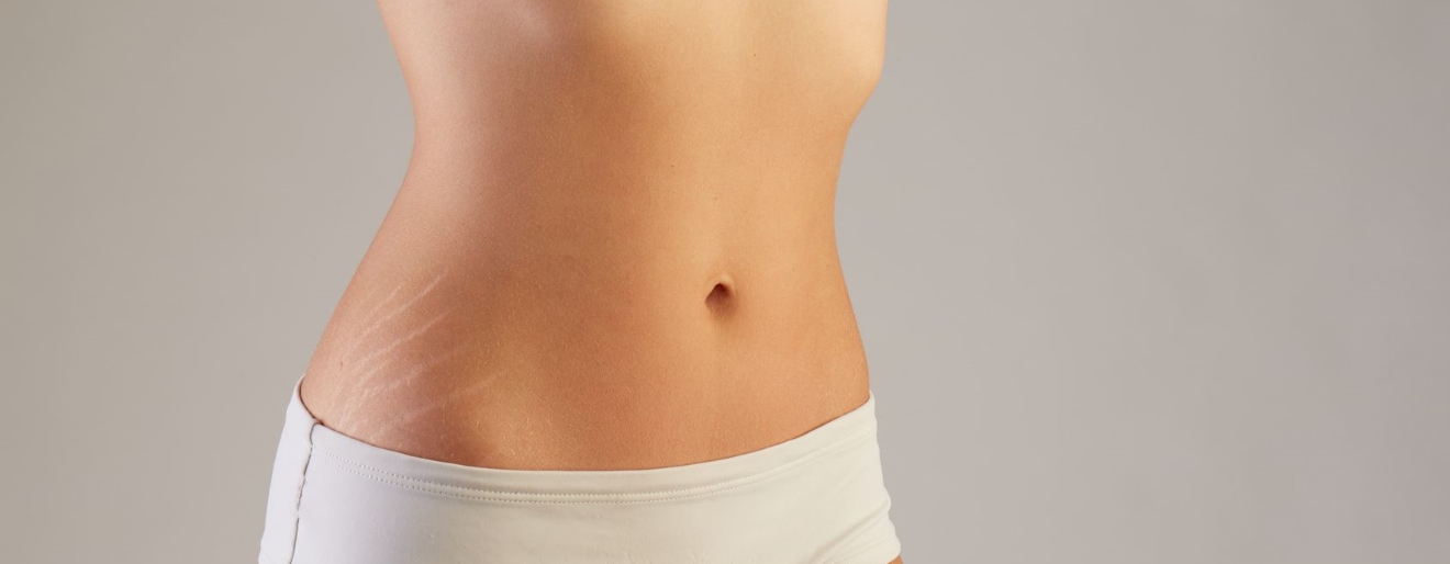 Jak wybrać skuteczny preparat na rozstępy?