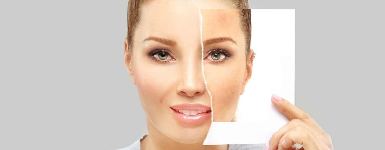 Przebarwienia skóry - jak zmniejszyć ich widoczność?