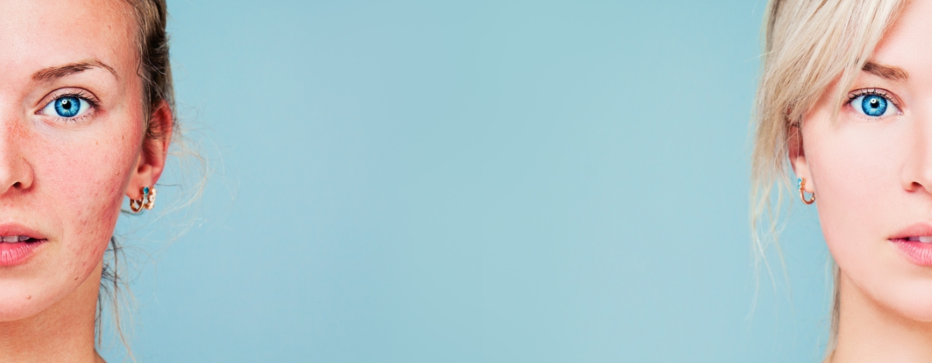 Trądzik różowaty - jak ukoić cerę?